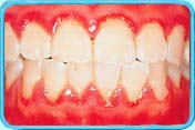 Photograph showing severe red, swollen and bleeding gums due to pregnancy gingivitis.