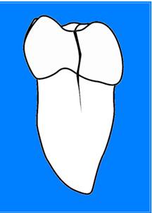 图中所见是一颗牙冠有裂纹的臼齿。