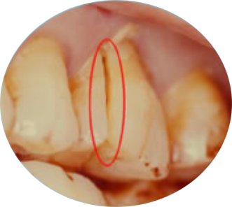 Photograph of a cracked teeth