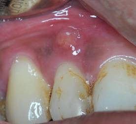 Photograph showing the presence of an abscess near a tooth.