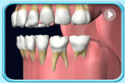 Animation showing a set of upper and lower deciduous teeth having their developing permanent successors underneath.