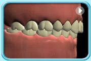 Animation showing projected teeth.