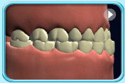 Animation showing teeth with reversed bite.