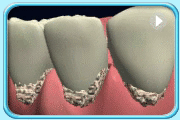 Animation of a few teeth and their periodontal tissues showing accumulation of plaque along the gum margin. The toxins released leads to red and swollen gums.