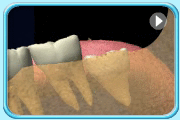 Animation showing normal growth of a wisdom tooth. The tooth crown can normally erupt and align with the adjacent tooth.