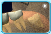 Animation showing abnormal growth of a wisdom tooth. Its growth is that grows slanted and hindered by the tooth in front, resulting in its tooth crown is being partially buried inside the jawbone.