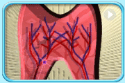 Animation showing inflammation of the pulp is being caused by tooth decay.