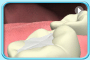 动画所见是下排第二大臼齿所置放的补牙物料过高，以致上下排牙齿不能正常合拢。