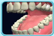 Animation showing  an unfit denture affecting the normal movement of upper and lower jaws.
