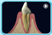 Animation of a tooth and its periodontal tissues. The periodontal tissues are receding, resulting in the loosening of tooth due to the loss of support.