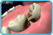 Photograph of an impacted wisdom tooth growing slanted towards its adjacent tooth. The adjacent surfaces of the teeth are decayed.