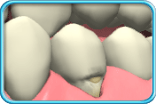 图中所见是一颗牙齿的牙龈已经萎缩，露出的牙根有部分已被刷蚀。