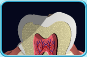 圖中所見是一顆牙齒的縱切面，可見此牙齒己經崩裂。