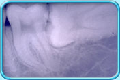 图中所见是一张X光片，显示智慧齿横向前牙生长，牙冠撞及前牙，形成阻生智慧齿。