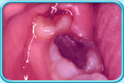 Photograph showing an erupting lower wisdom tooth having its overlying gum red, swollen and bleeding.