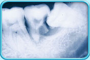 Photograph of an x-ray film showing an impacted wisdom tooth growing slanted towards its adjacent tooth the root of it is resorbed.