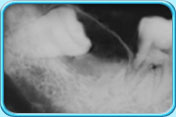 Photograph of a x-ray film showing cyst formation caused by an impacted wisdom tooth.