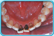 Photograph of black stains on the inner surfaces of lower front teeth.