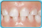 Photograph of a set of deciduous front teeth having the black tooth decay removed and then restored by a tooth-coloured filling.