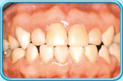 Photograph of a set of front teeth after filling with composite resin.