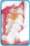图中所见是下排后牙其中一颗臼齿的咀嚼面涂有牙面氟化物剂。