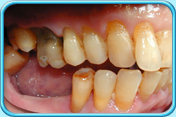 Photograph of a set of permanent teeth with gum recession and exposed root surfaces.