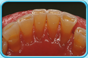 Photograph of a set of lower teeth having exposed dentine due to habitual grinding of teeth.