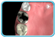 Animation showing early shedding of deciduous teeth resulting in poor alignment of their permanent successors.