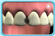 動畫所見是以牙科工具清除兩顆上排正門牙蛀壞的部分，並以複合樹脂填補蛀洞的過程。