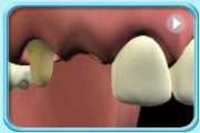 動畫所見是把單端固定牙橋套在已給處理的牙齒上的過程。