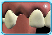 动画所见是把树脂黏合式牙桥黏贴在已给处理的牙齿上的过程。