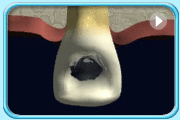 動畫所見是清除全部牙髓的牙髓治療過程。