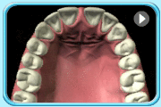 Animation showing the process of extracting a deeply impacted tooth with surgery.