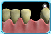 Animation of the process of how the fixtures are being inserted into the jawbone.  The gum flap is raised and holes are drilled into the jawbone, followed by the insertion of  the fixtures of implants and  closing the gum flap.