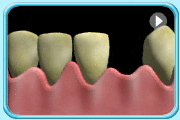 Animation of the process of placing the healing abutment onto the implant. The small piece of gum covering the dental implant was removed and a healing component was inserted onto the dental implants.