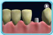 Animation of the process of false teeth fitting onto the dental implants.