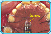 Photograph of an upper jaw and the orthodontic appliances showing the position of screws.