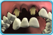 Photograph of upper front teeth showing that there is a missing tooth and its adjacent teeth have been treated.  Underneath it is a bridge ready to be fitted into the space and the real teeth.