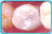 Photograph of the appearance of a decayed tooth after a filling is placed.