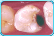 Photograph of the appearance of a decayed tooth before filling is placed.