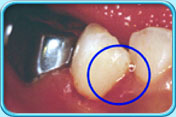 图中所见是乳齿原本蛀坏的部分以玻璃离子树脂填补后的外貌。