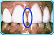 圖中所見藍圈內是兩顆上排正門牙經處理後，兩牙之間的縫隙細了。