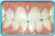 图中所见是上下排原本有色斑的牙齿，经处理后色斑都给遮盖了。