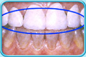 Photograph showing the upper teeth restored with porcelain laminate veneers.