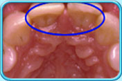 Photograph of the appearance of two upper front teeth before replacement with crowns.