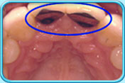Photograph of the appearance of two upper front teeth after replacement with porcelain crowns.
