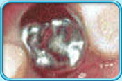 Photograph showing a stainless steel crown was placed on a deciduous molar.