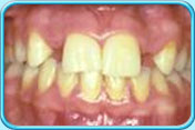 图中所见是上下排前牙于接受镶配牙桥前的外观，可见上排左右都欠缺一颗侧门牙。