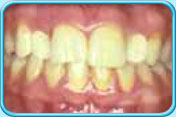 Photograph of front teeth after replacement with dental bridge showing the replacement of the lost lateral incisors.