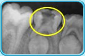 Photograph of an x-ray film indicating a deciduous molar with vital pulp.